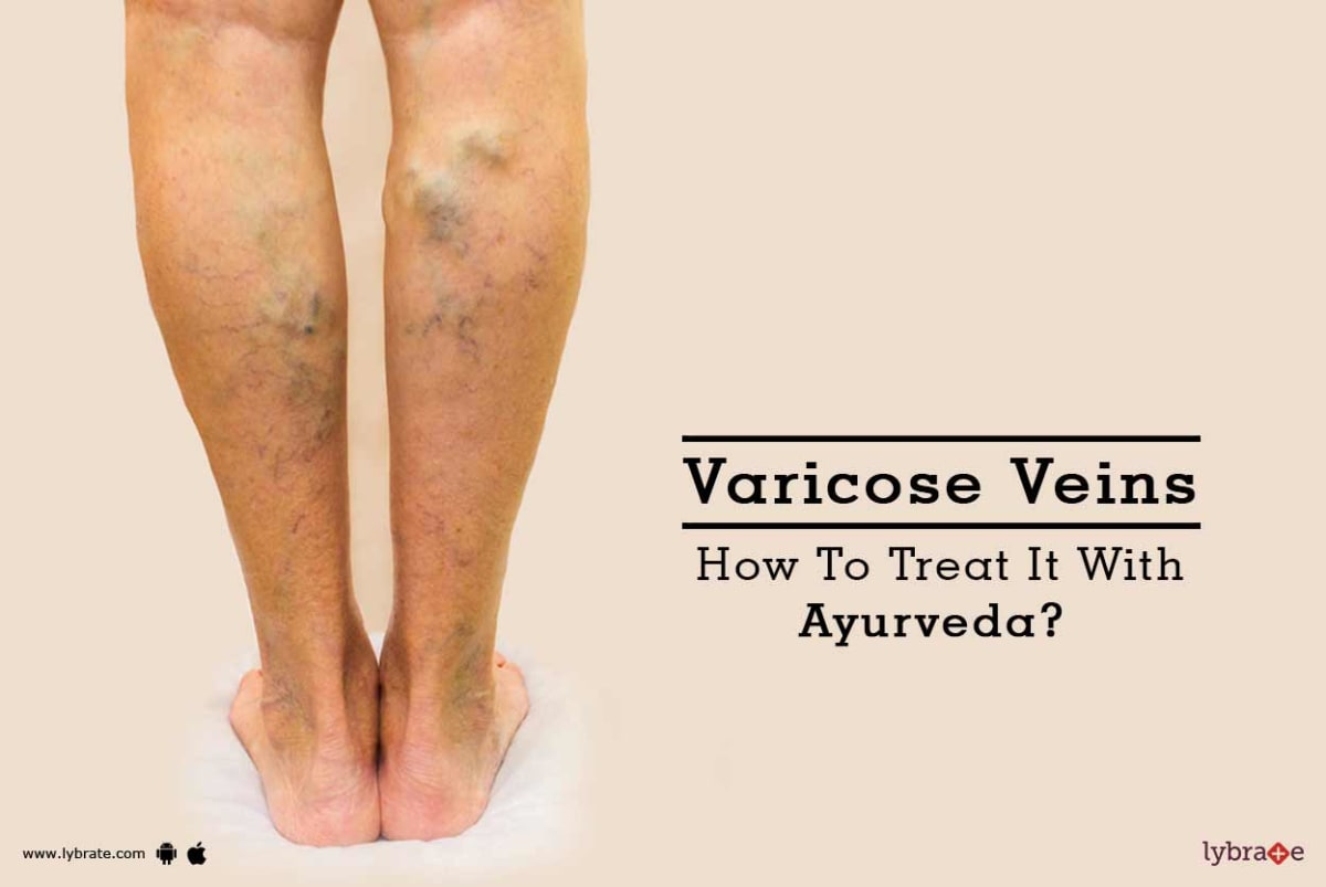 Herbs for reducing symptoms of varicose veins